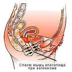 Наиболее распространенными симптомами вагинизма являются спазмы мышц влагалища