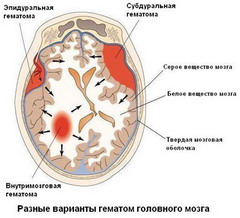 Виды внутричерепных гематом