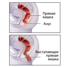 Выпадение прямой кишки у мужчин