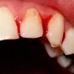 При кровоточивости десен следует обратиться к стоматологу