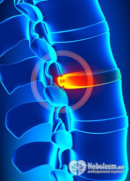 Как можно снять боль при грыже позвоночника