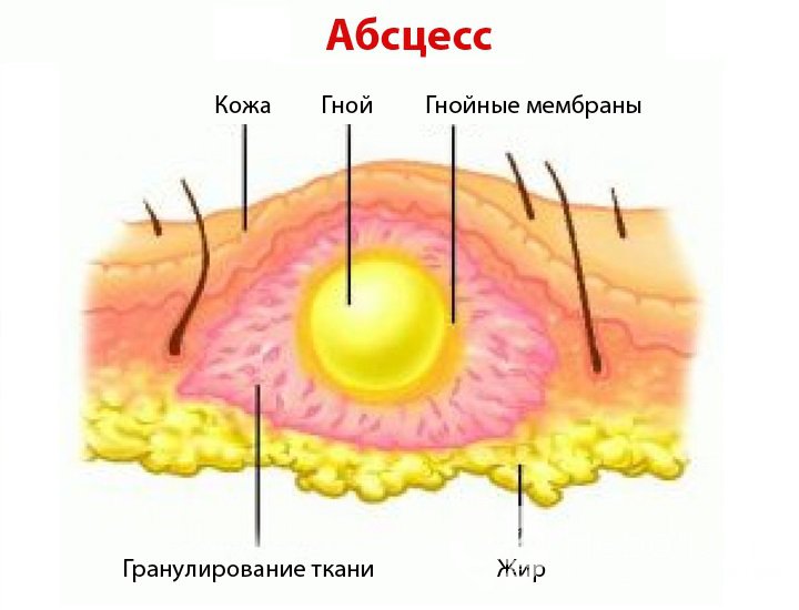 Признаки абсцесса