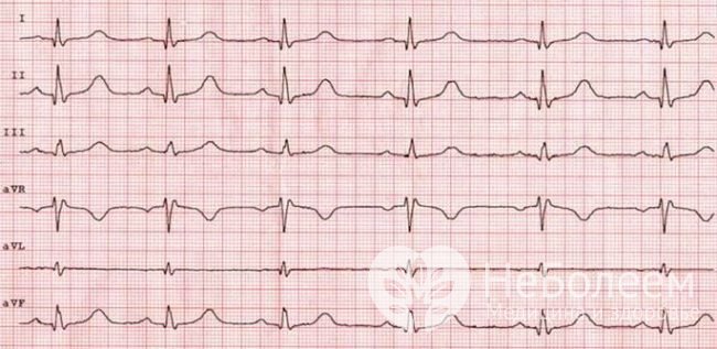 ЭКГ – метод диагностики недостаточности коры надпочечников