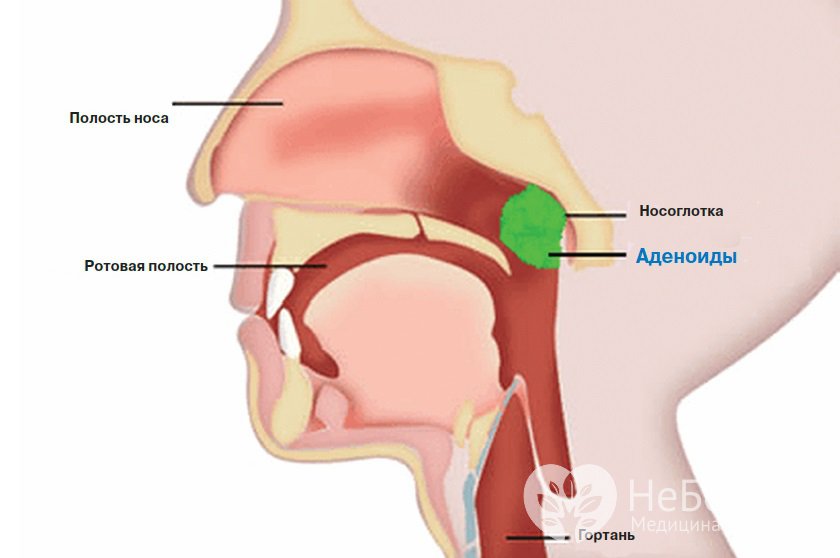 Признаки аденоидита