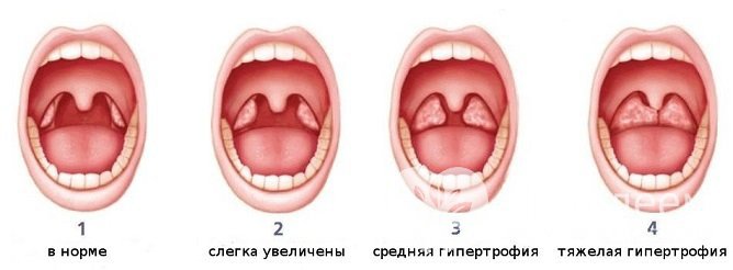 Стадии аденоидита