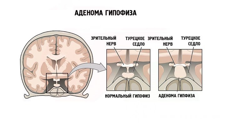 Признаки аденомы гипофиза