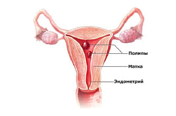 Как выглядят полипы эндометрия