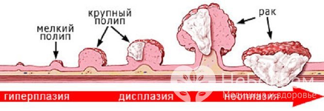 Стадии аденоматозного полипоза