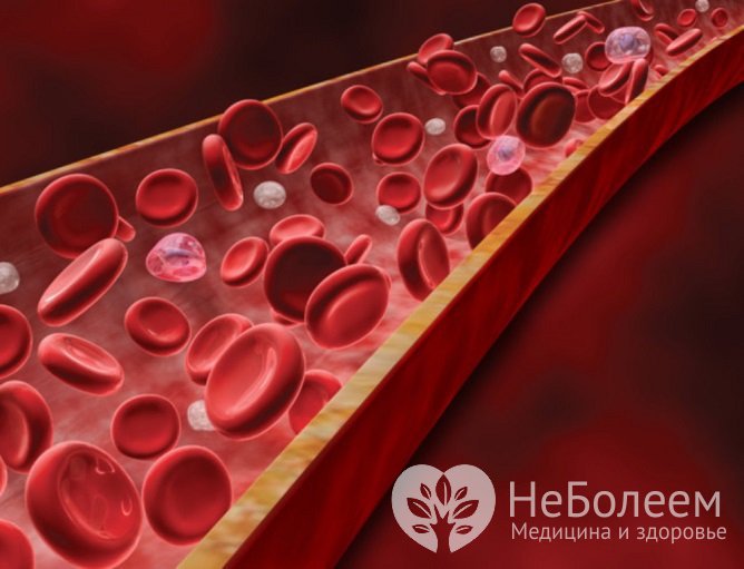 Агранулоцитоз характеризуется резким снижением гранулоцитов в периферической крови