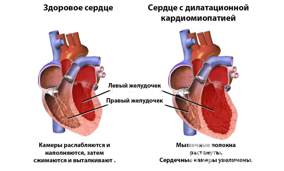 Симптомы алкогольной кардиомиопатии