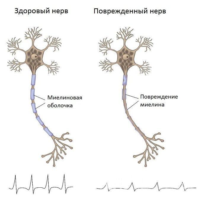 Как выглядит поврежденный нерв при алкогольной полиневропатии