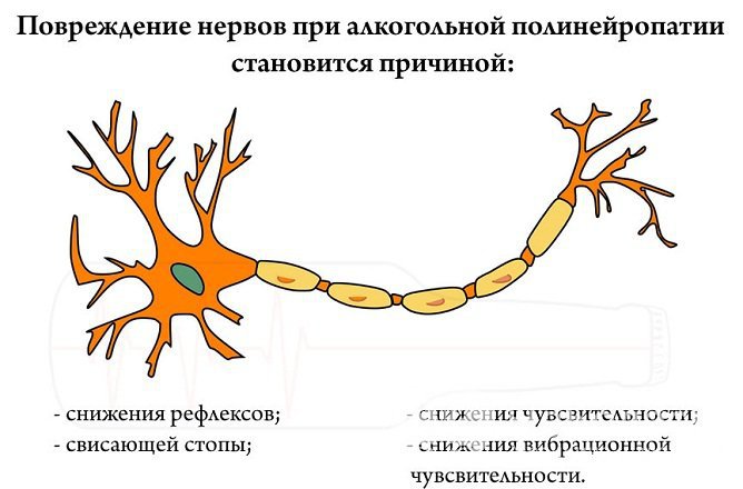 Алкогольная полинейропатия приводит ко множеству осложнений