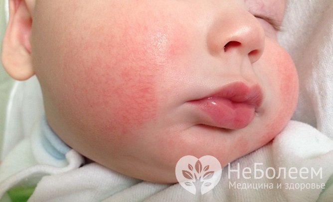 У детей аллергический дерматит первоначально проявляется как вариант пищевой аллергии