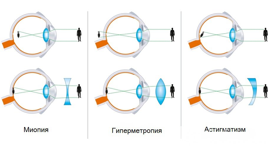 Формы и симптомы аметропии