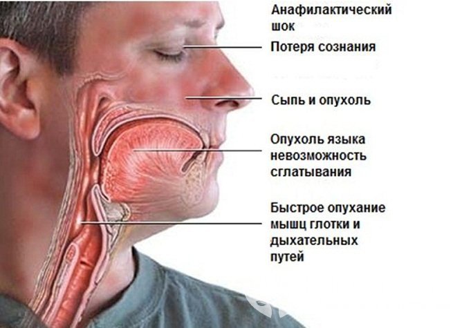 Симптомы анафилактического шока