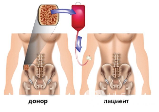 При анемии Фанкони показана пересадка костного мозга от донора