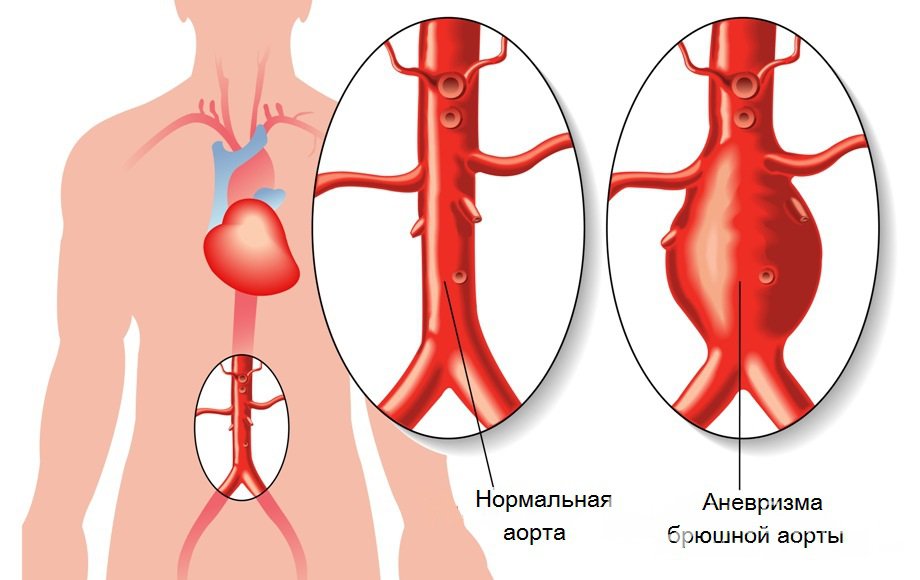 Симптомы аневризмы аорты
