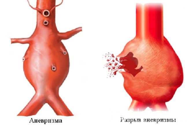 При разрыве аневризмы аорты человек в большинстве случаев погибает