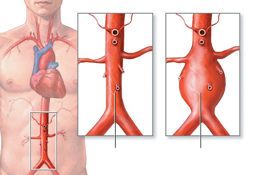 Признаки аневризмы брюшной аорты