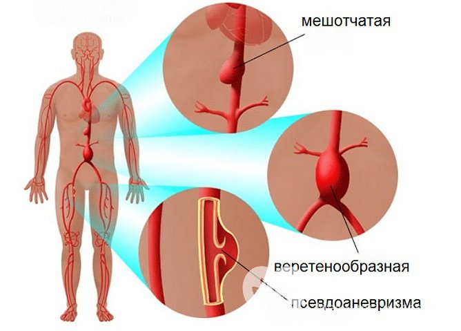 Типы аневризм