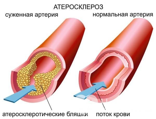 Основная причина аневризмы брюшной аорты – атеросклероз