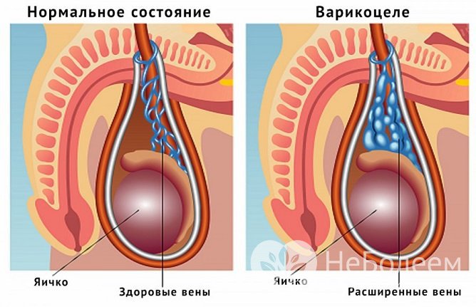 Когда аневризма сдавливает артерии и вены, у мужчины наступает варикоцеле