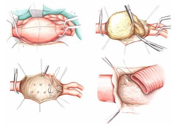 Операция по устранению аневризмы брюшной аорты называется аневризмэктомией