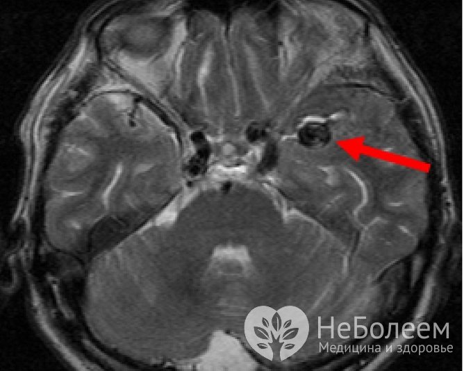Аневризма сосудов головного мозга на МРТ