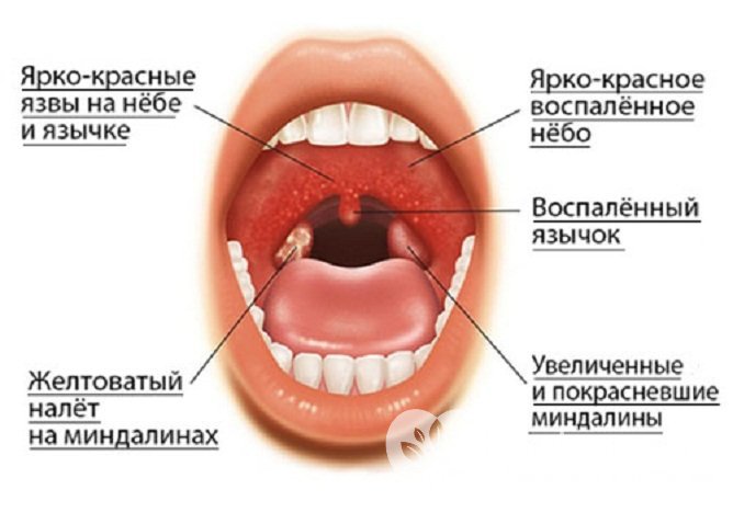 Основные симптомы, характерные для герпетической ангины