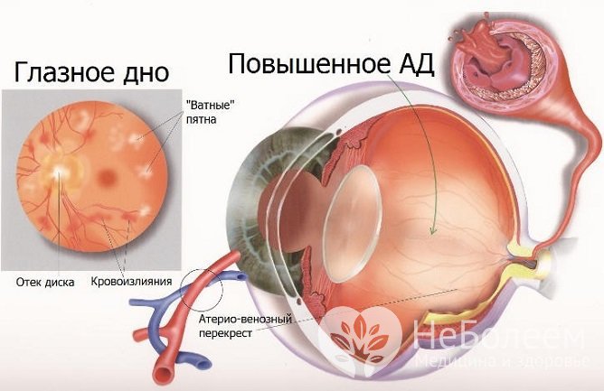 Ангиопатия сетчатки глаза по гипертоническому типу