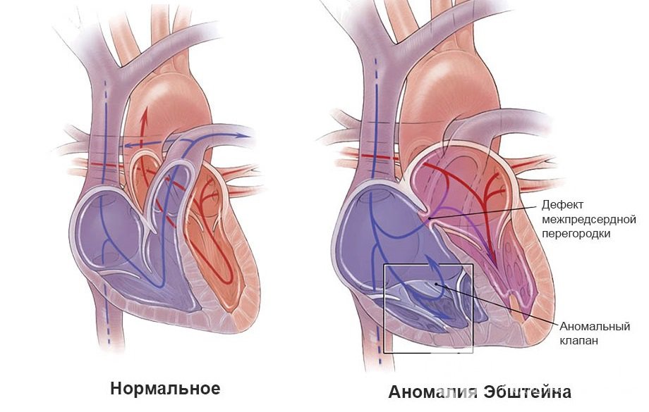 Симптоиы аномалии Эбштейна