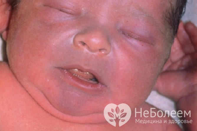 Дети с аномалией Эбштейна рождаются с цианотичным окрашиванием кожи