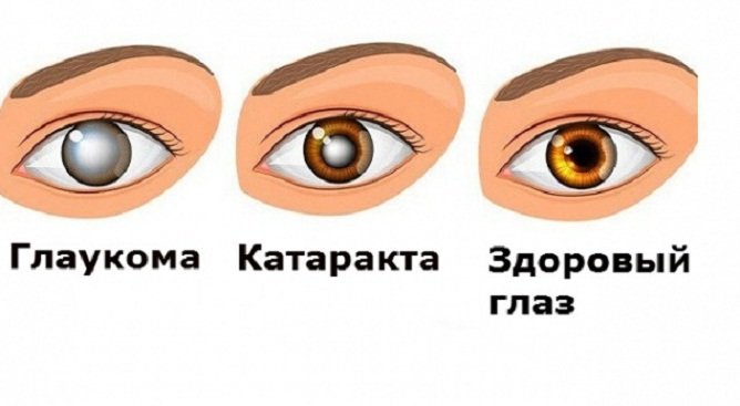 Чаще всего анопсия развивается на фоне заболеваний глаз: глаукома, катаракта и др.