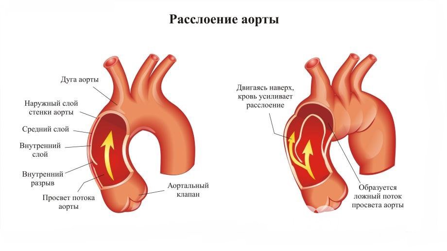 Расслоение аорты - осложнение аортита