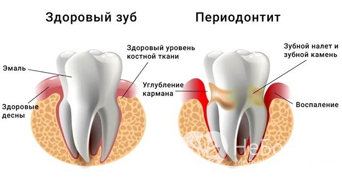 Клиническая картина апикального периодонтита