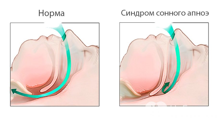 Симптомы апноэ сна