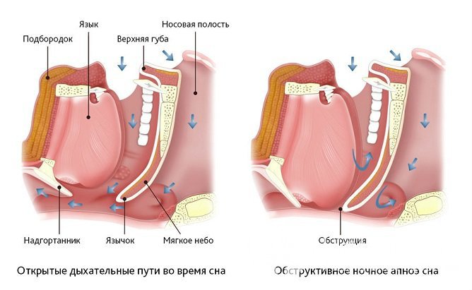 Обструкция верхних дыхательных путей – основная причина апноэ сна