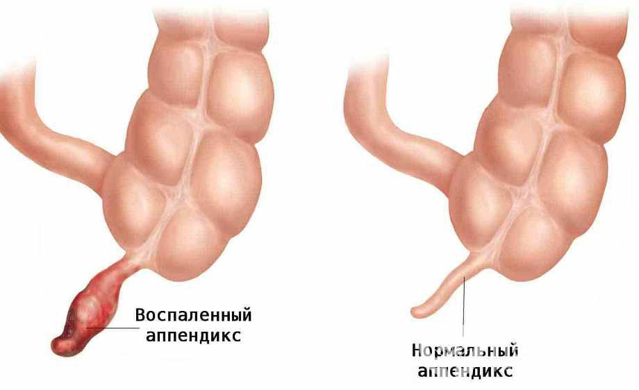 Симптомы аппендицита у детей