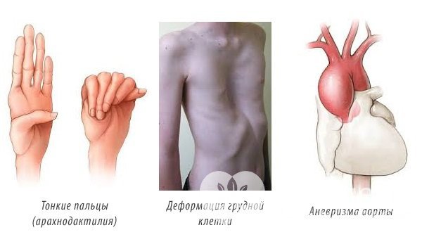 Арахнодактилия и другие признаки при синдроме Марфана