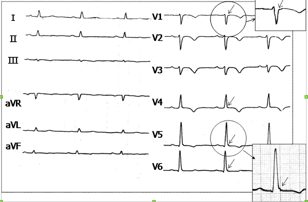 Аритмогенная дисплазия правого желудочка: результаты ЭКГ