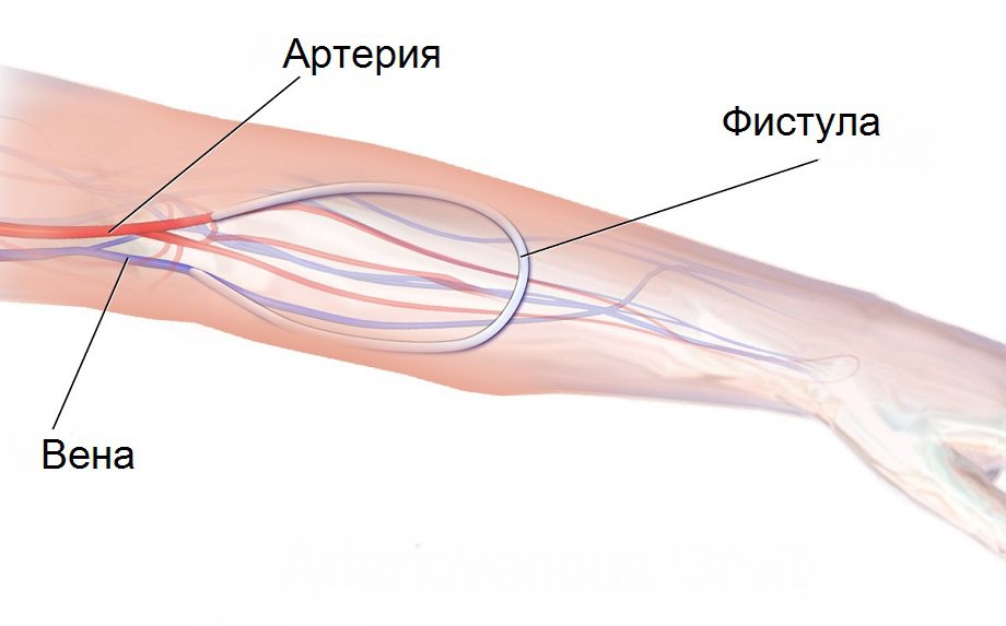 Признаки артериовенозной фистулы