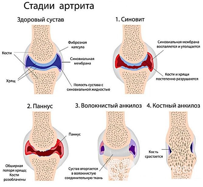 Стадии артрита