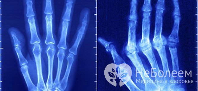 Артрит пальцев рук на рентгеновском снимке