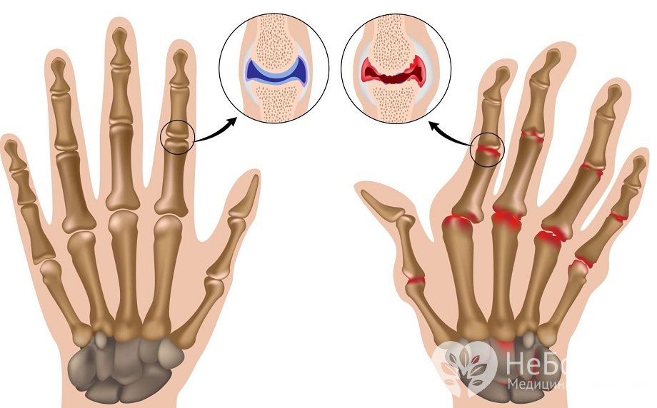 Симптомы артрита
