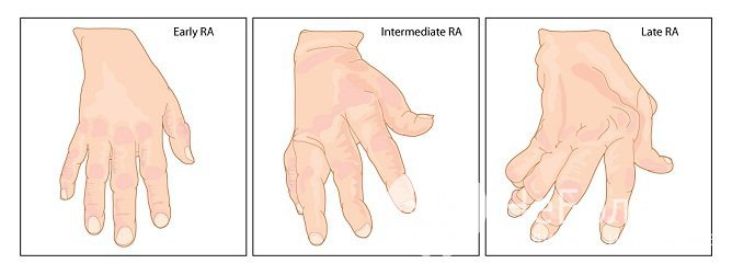 Стадии ревматоидного артрита
