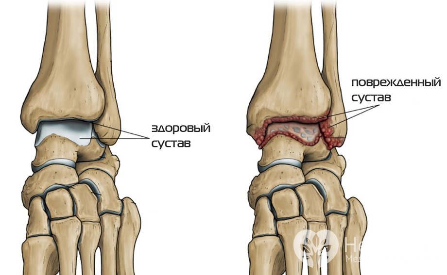 Признаки артроза голеностопного сустава 
