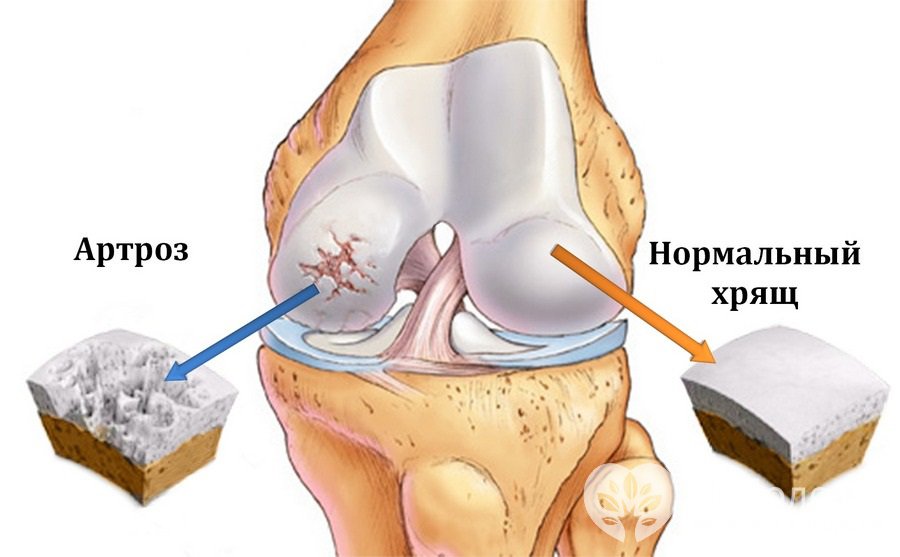 Признаки артроза коленного сустава