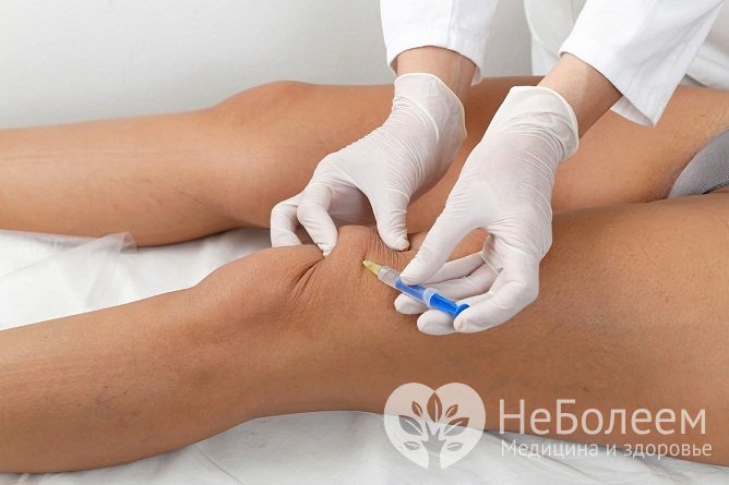 При артрозе коленного сустава 1-2 степени назначают хондропротекторы и внутрисуставные инъекции кортикостероидных гомонов