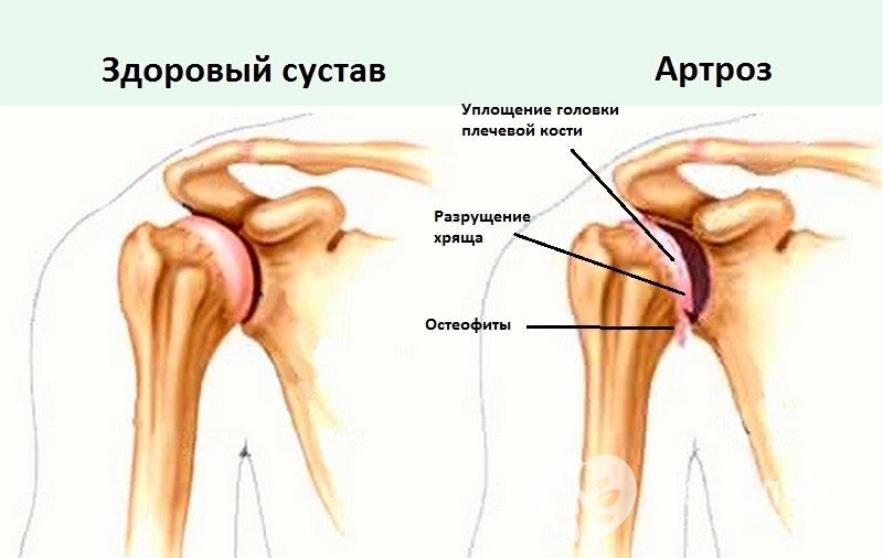 Признаки артроза плечевого сустава