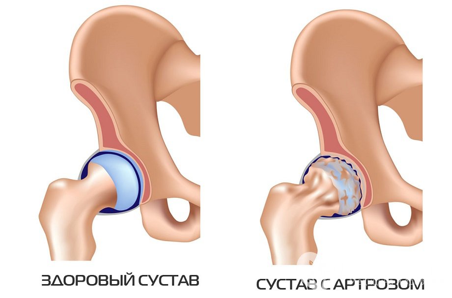 Признаки артроза тазобедренного сустава